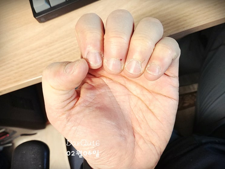 [손톱뜯기습관교정과정] 약 2달여간 변화된 손가락과 손톱 모습