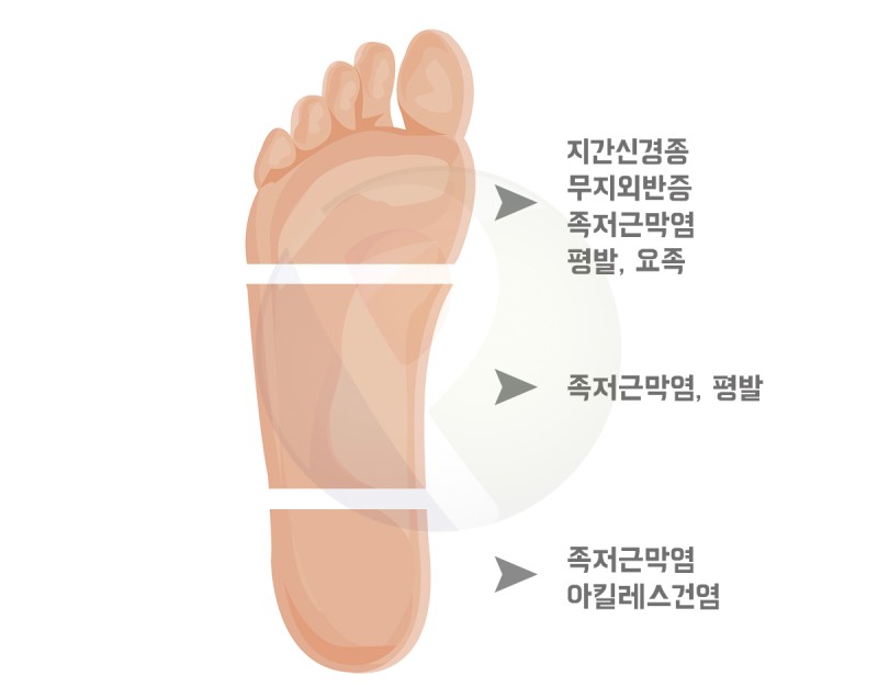셋째, 발가락 밑 통증의 원인, 발바닥이 아픈 이유 - 바디밸런스운동건강연구소