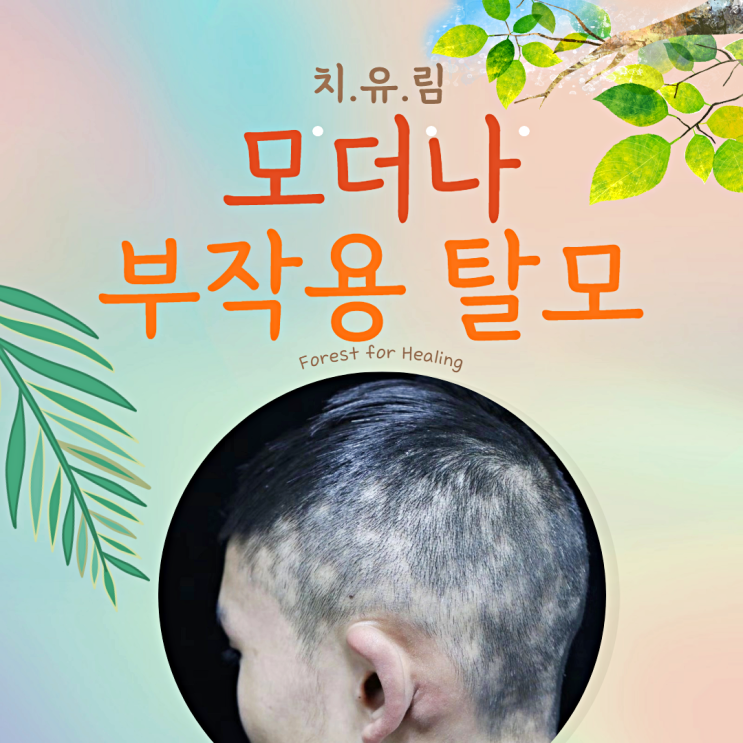  모더나 부작용 탈모, 전혀 가능성이 없다고?