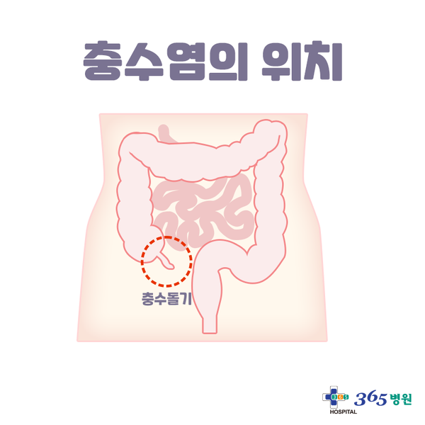  [창원마산 척추관절 디스크 365병원] 급성 충수염(맹장염)