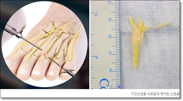  지간신경종 치료법, 정형외과 전문의가 총정리합니다