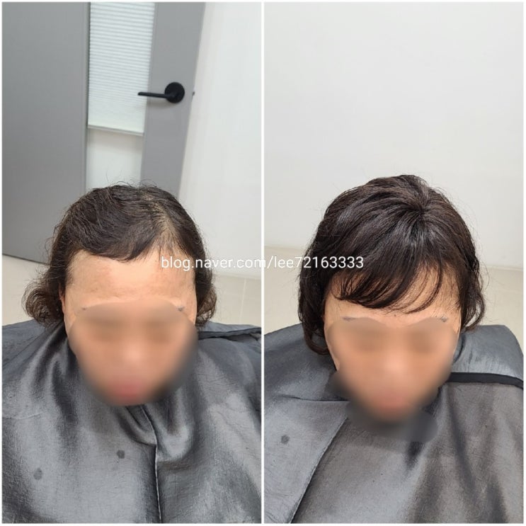  있는 가발 다 버리고 보톡스증모!! 가볍고 티나지않아 자연스러워~