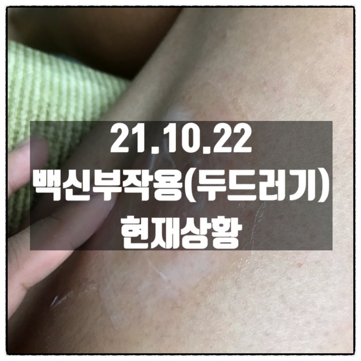 [21.10.22] 오늘 아침 현재 화이자부작용(두드러기)상황..