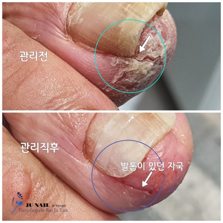 우리엄마 발톱이 너무아프답니다. 제발 참지말고 얘기합시다. /성남수원수지보정동백죽전동/주네일/무좀파고드는내향성발톱손톱변형전문점 우리엄마 발톱이 너무아프답니다. 제발 참지말고 얘기합시다. /성남수원수지보정동백죽전동/주네일/무좀파고드는내향성발톱손톱변형전문점