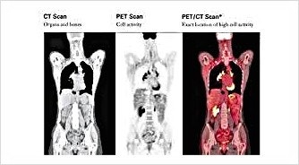 암 종양 표지자 수치, 자각 증상, 건강 검진, 복부 CT MRI PET