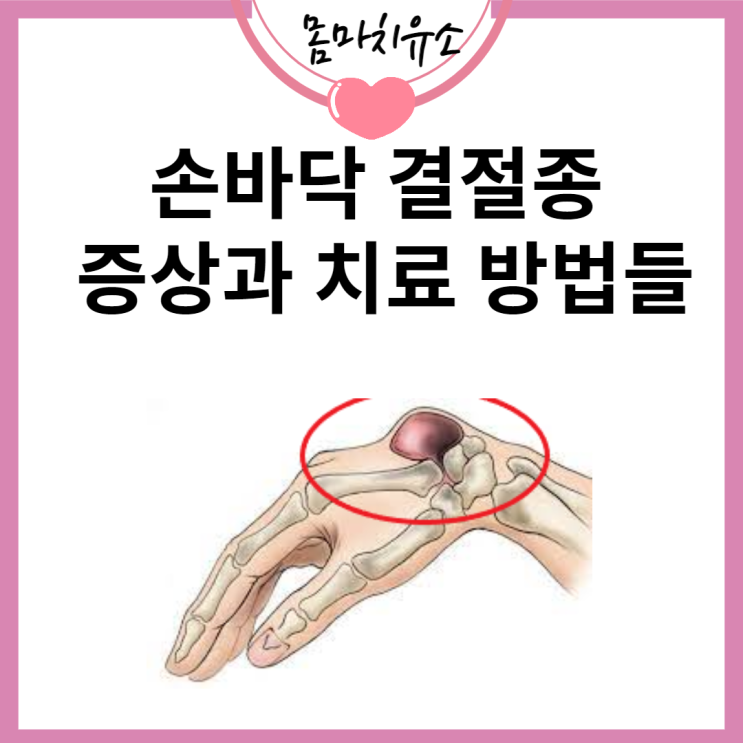 손바닥 결절종 증상과 치료 방법들