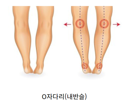 [서래마을PT]O자 다리 교정운동(누워서 하는 운동 편)