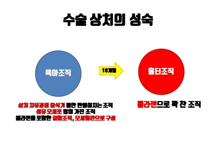  쌍수 후 눈당기는 증상을 줄이려면 가급적 자연유착 쌍수나 매몰 쌍수를 하시는 것이 좋아요.