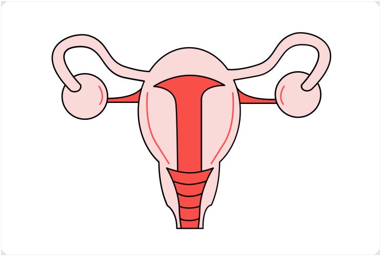  장막하근종? 수술만이 정답이 아닙니다.