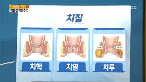  치질치핵 원인증상특징 진행단계완치율 외과수술치료부작용 내치핵외치핵 예후경과합병증 간호중재진단