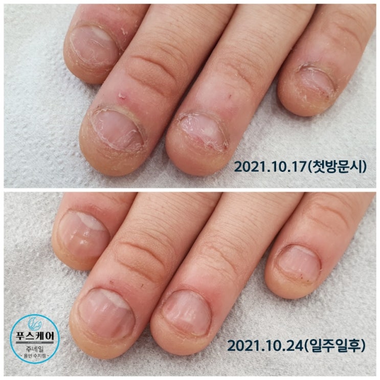 죽을만큼 고치기 힘들었던 역대급 물어뜯는 손톱 7일만에 이렇게 변했어요. /성남수원수지보정동백죽전동/주네일/무좀파고드는내향성발톱손톱변형전문점 죽을만큼 고치기 힘들었던 역대급 물어뜯는 손톱 7일만에 이렇게 변했어요. /성남수원수지보정동백죽전동/주네일/무좀파고드는내향성발톱손톱변형전문점
