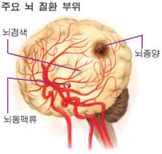  뇌혈관연축 원인이유 임상증상 치료진단법 뇌출혈주요합병증 혈관수축허혈예후경과 간호중재과정
