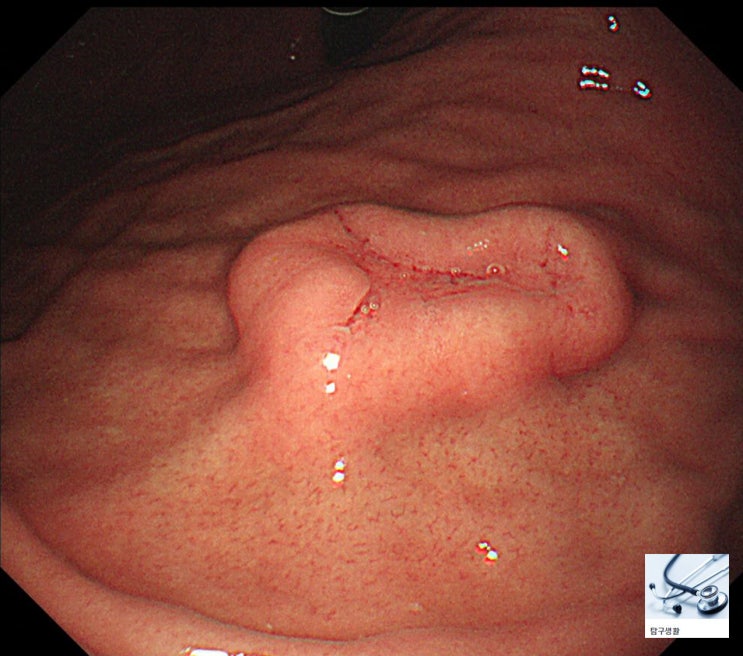  [case] 위 신경내분비 종양 (Gastric neuroendocrine tumor, Gastric NET)