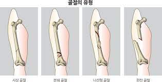  골절 원인 임상증상유형 응급대처법 진단치료 개방폐쇄단순복합 골절종류 예후합병증 간호중재진단