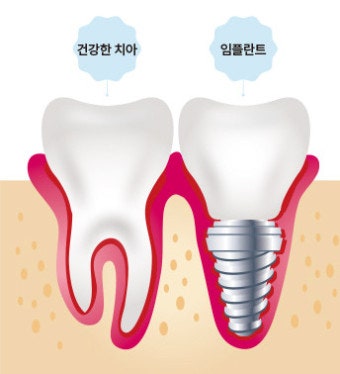 천호동 임플란트를 잘하는 곳의 임플란트 기간을 단축하기 위해서는