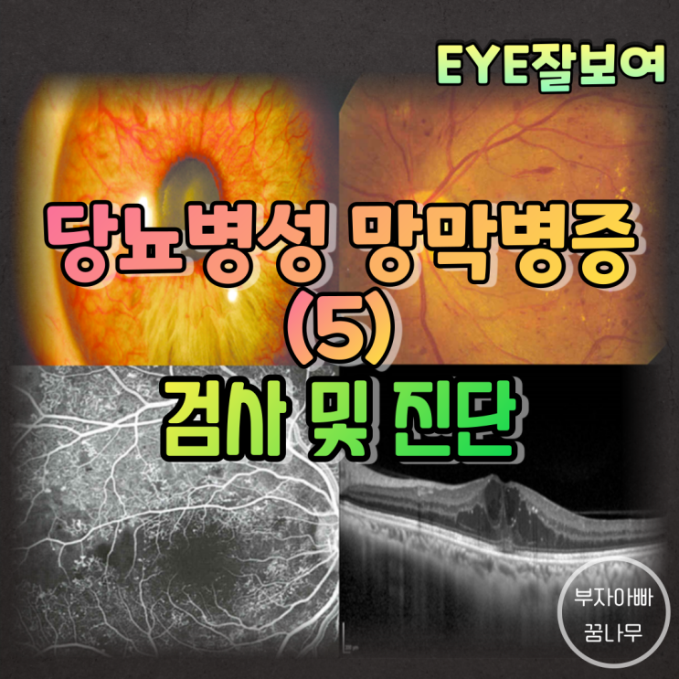  [EYE잘보여] 당뇨병성 망막병증 (5) - 진단(전안부 검사, 안저검사, 형광안저혈관조영술; FAG, 빛간섭단층촬영; OCT)