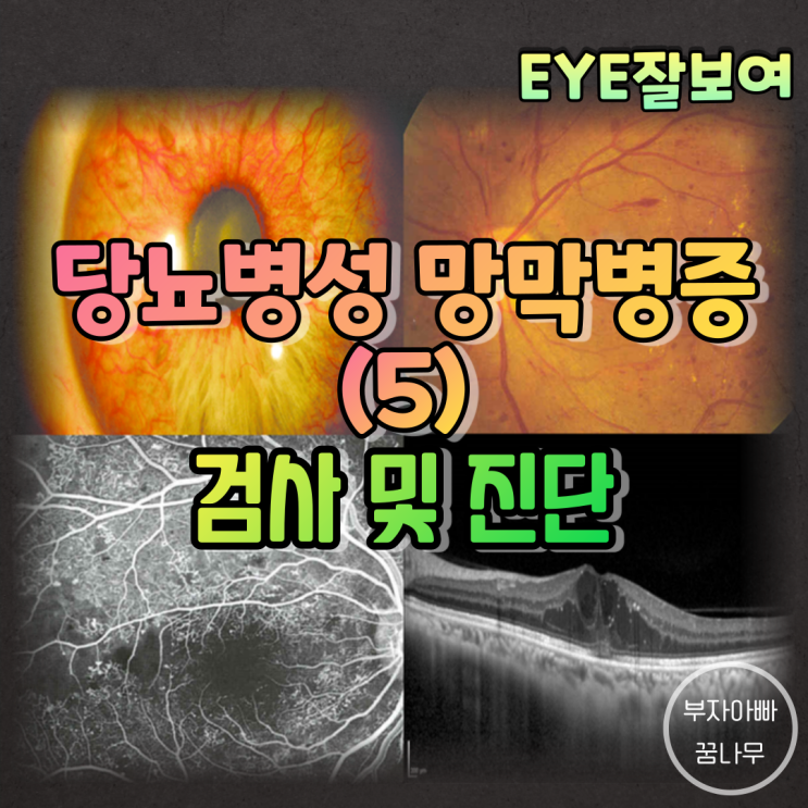 [EYE잘보여] 당뇨병성 망막병증 (5) - 진단(전안부 검사, 안저검사, 형광안저혈관조영술; FAG, 빛간섭단층촬영; OCT)