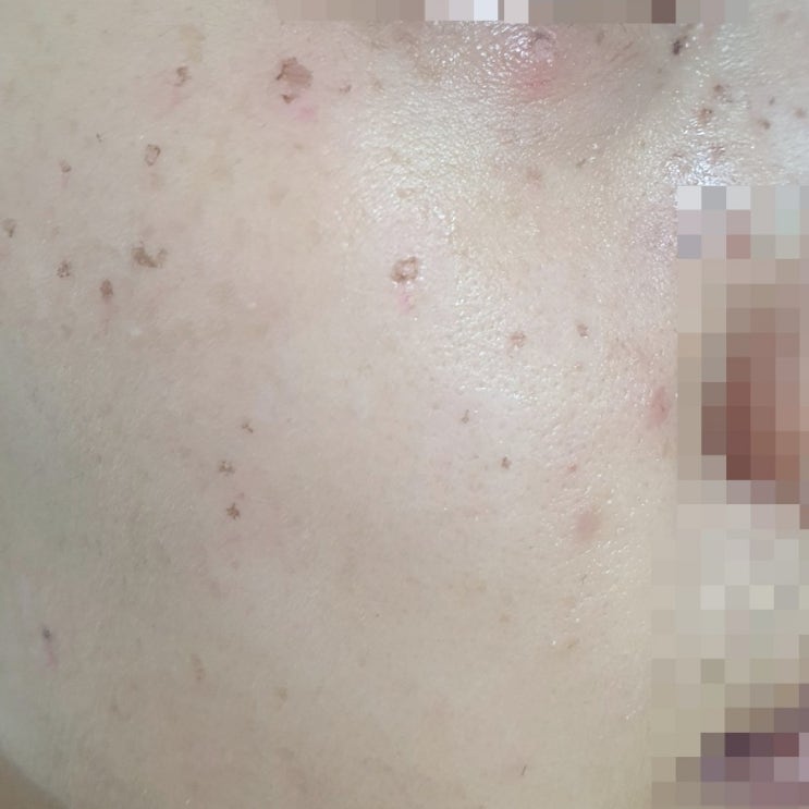  [내돈내산]주근깨제거 루비레이저 시술 후기2: 일주일 기록, 전/후 사진