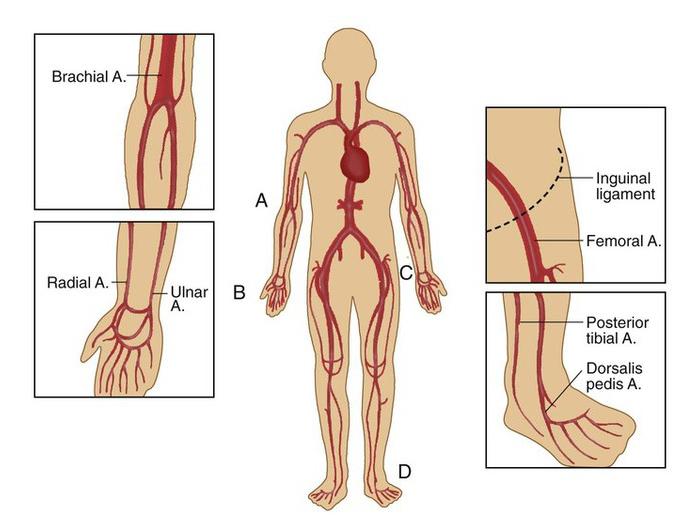  Arterial line(A-line)의 모든 것 : 준비물, 동맥위치(Radial artery 등), zeroing, 잡는 방법(insertion), pressure bag