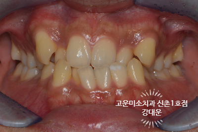  [성인교정] 비대칭과 덧니 치아교정