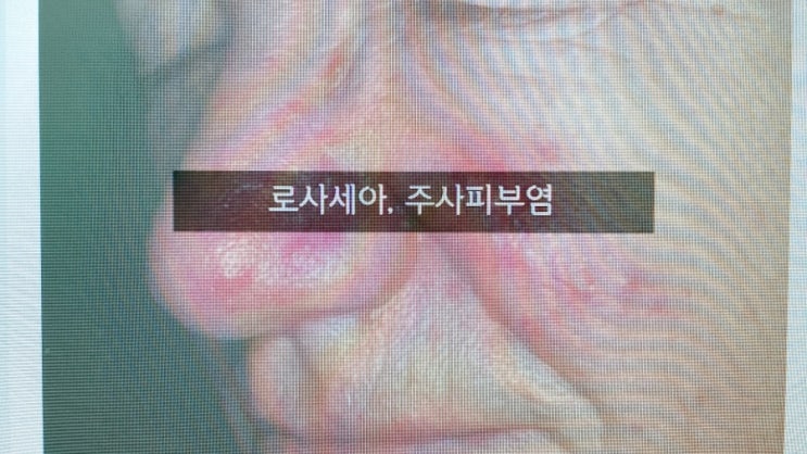  로사세아 (rosacea, 주사피부염) 얼굴 홍조가 너무 심해요