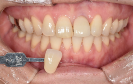 언주역 치과? "현직 치과의사"가 쓰는 라미네이트, 미백 치료 사례