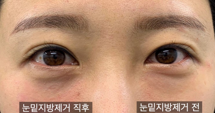  압구정 눈밑지방재배치- 그게 정말 최선입니까?