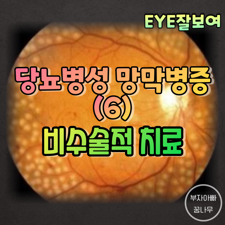  [EYE잘보여] 당뇨병성 망막병증 (6) - 비수술적 치료: 레이저(범망막광응고술, PRP; PanRetianl Photocoagulation), 유리체강내 약물주입술