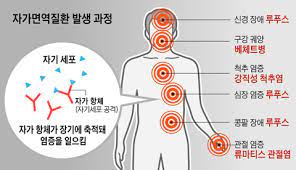  자가면역질환 원인증상 간호치료 류마티스질환 전신홍반성낭창 면역결핍질환 항체항원반응 간호중재진단