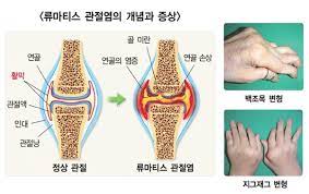  류마티스관절염 원인증상 통증특징 진단기준 결절합병증 강직위축기형변형 생존사망율 간호진단과정