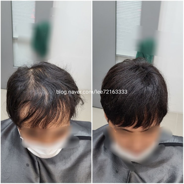  보톡스증모술 2년째 사용후기! 망 가발은 가라~ 새로운 헤어 증모술!! 4개월간고정했다구?