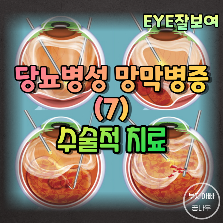  [EYE잘보여] 당뇨병성 망막병증 (7) - 수술적 치료(수술 대상, 수술 목적, 수술 방법, 수술 중&후 합병증)
