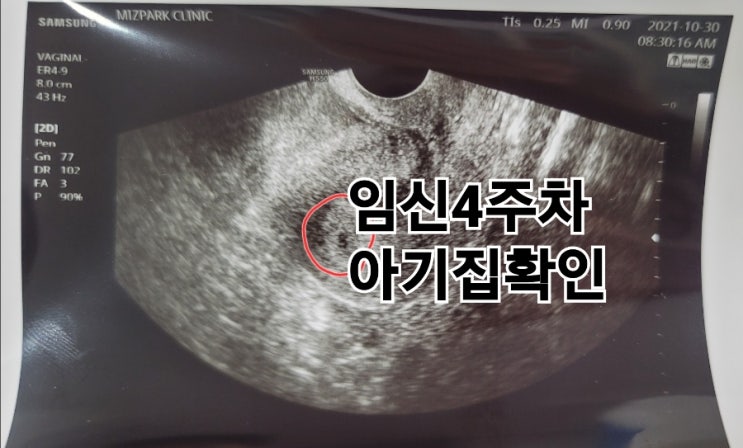  임신4주차 애기집 확인(초음파 태낭)