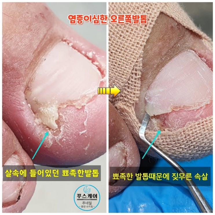 아토피때문에도 너무힘든데 엄지발톱 염증과 발톱통증으로 아파서 똑바로 걷기가 힘들어서 파고드는내향성발톱 전문 푸스케어 용인 주네일 찾아주셨어요.