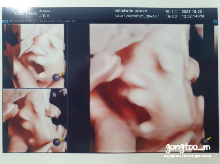 임신 28w1d :: 28주 태아 입체초음파 / 입체초음파 사진, 가격, 아 / 아가는 누굴 닮았을까?