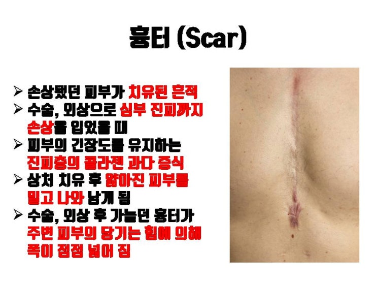  절개 쌍수 후 흉터가 심하게 남은 경우 너무 걱정하지 마세요. 쌍꺼풀 재수술로 교정 가능해요!!!