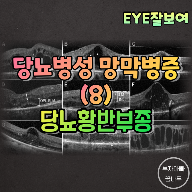 [EYE잘보여] 당뇨병성 망막병증 (8) - 당뇨황반부종(Diabetic Macular Edema; DME): 정의, 발병기전, 진단 및 검사, 치료