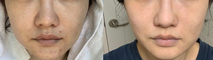  홍대스킨부스터 쁘가티주사 효과 솔직후기(전,후 있음)