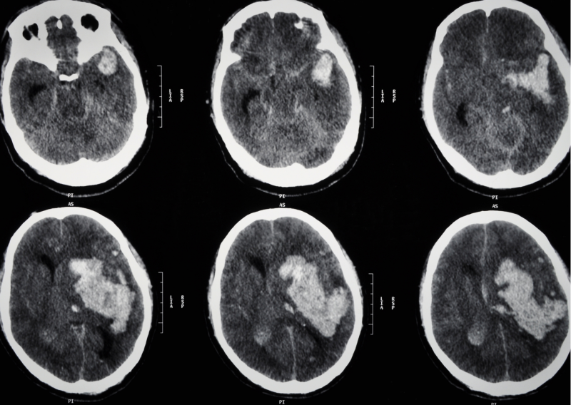 뇌 CT, MRI, MRA 의 차이점은? : 네이버 블로그