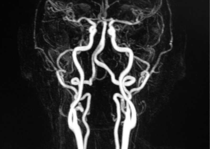 뇌 CT, MRI, MRA 의 차이점은? : 네이버 블로그