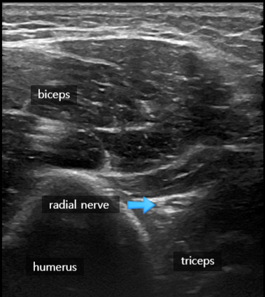 Radial nerve block 요골 신경 차단술(1) : 요골신경 주행 방향과 초음파, 적응증