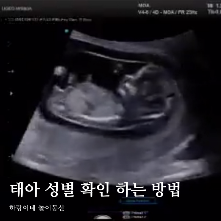태아 성별 확인 시기 임신 12주 각도법 아기 삼각점 판독