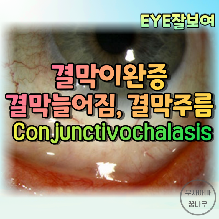 [EYE잘보여] 결막이완증(Conjunctivochalasis); 결막늘어짐, 결막주름, 늘어진 흰동자 - 원인, 증상, 진단, 분류, 치료