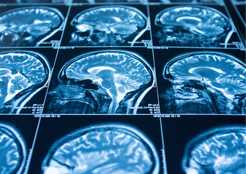 뇌 CT, MRI, MRA 의 차이점은? : 네이버 블로그