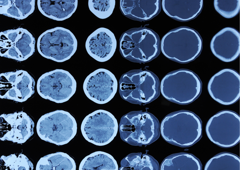 뇌 CT, MRI, MRA 의 차이점은? : 네이버 블로그