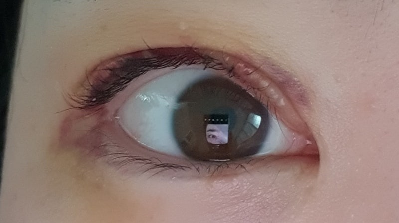 대전 안과 쌍수(안검하수) 수술후기