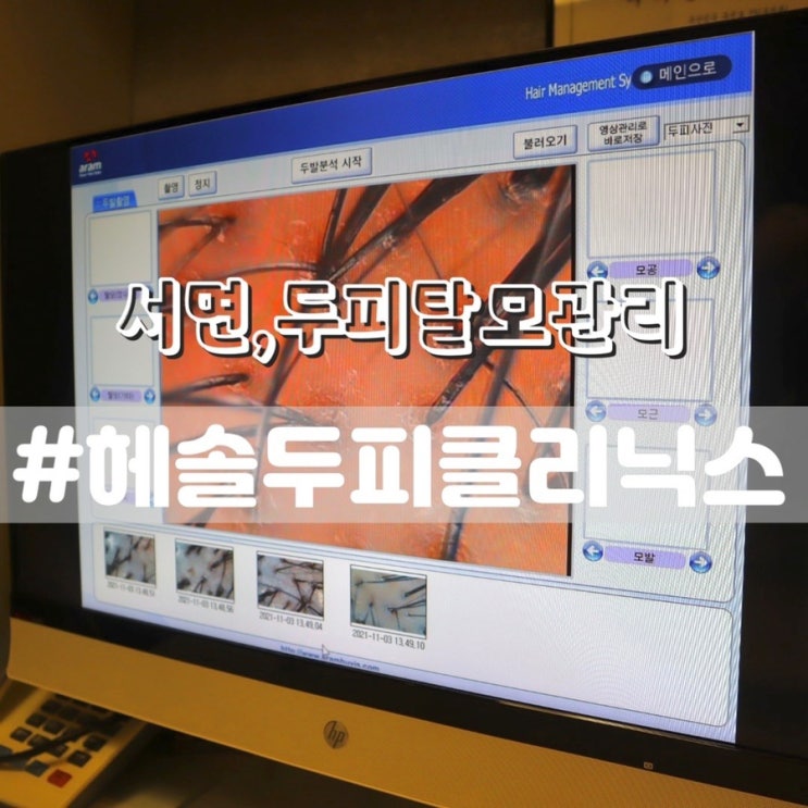  [서면탈모/부산탈모] 헤솔두피클리닉스 서면점/ 초기탈모예방개선관리 받고온 후기!!
