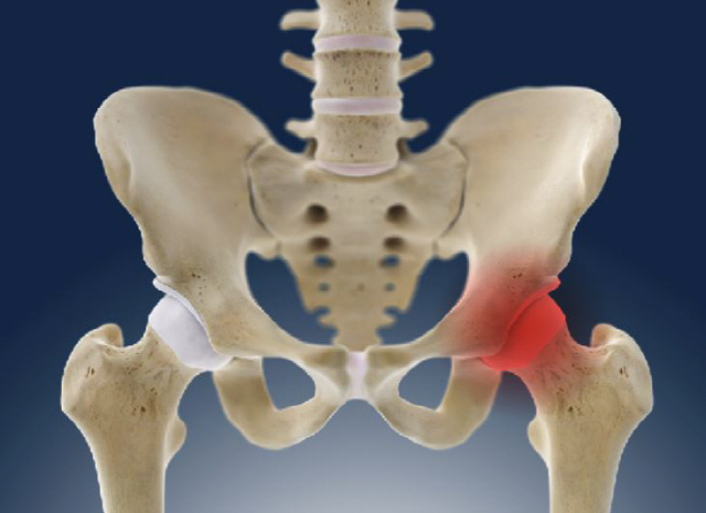 잦은 술자리, 뼈가 죽는다…찌릿한 엉덩이 통증 '대퇴골두 무혈성 괴사' 의심해봐야