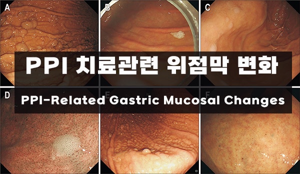 PPI 치료 관련 위점막 변화 (Proton Pump Inhibitor-Related Gastric Mucosal Changes)