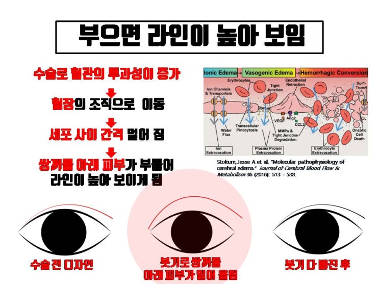  쌍꺼풀 수술 전 디자인만 잘 하면 붓기에 상관 없이 원하는 높이의 쌍꺼풀 얻을 수 있어요.